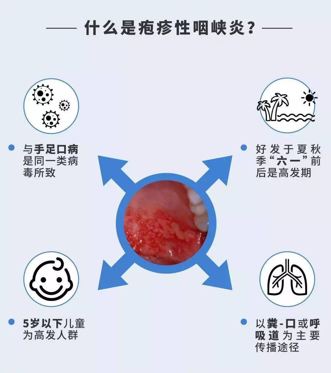 脾氨肽口服溶液治疗疱疹性咽峡炎的免疫功能变化与临床疗效